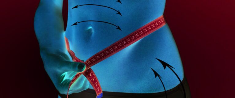 reduction in subcutaneous fat of the abdomen and sides following weight loss in one week